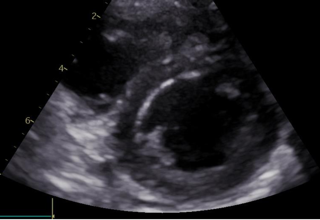 Echocardiography for extracorporeal membrane oxygenation