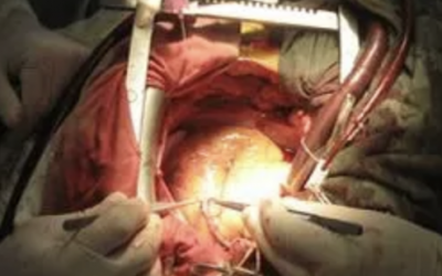 Enquête sur la PEC du risque de saignement per-op en chirurgie cardiaque