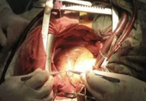 Enquête sur la PEC du risque de saignement per-op en chirurgie cardiaque